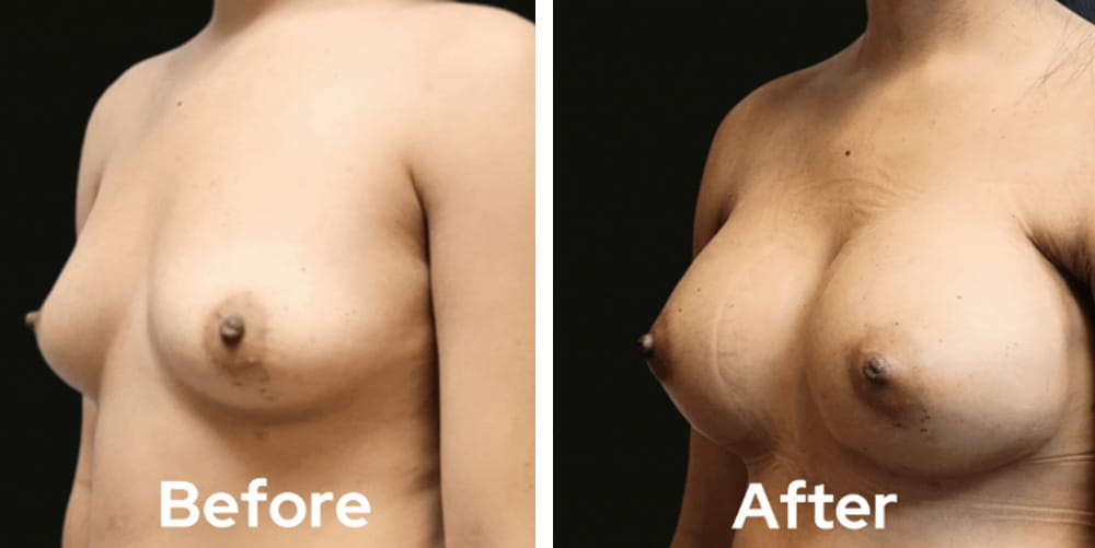Breast Augmentation-dr-garg-before-after-02