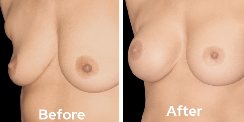Breast Augmentation-dr-garg-before-after-03