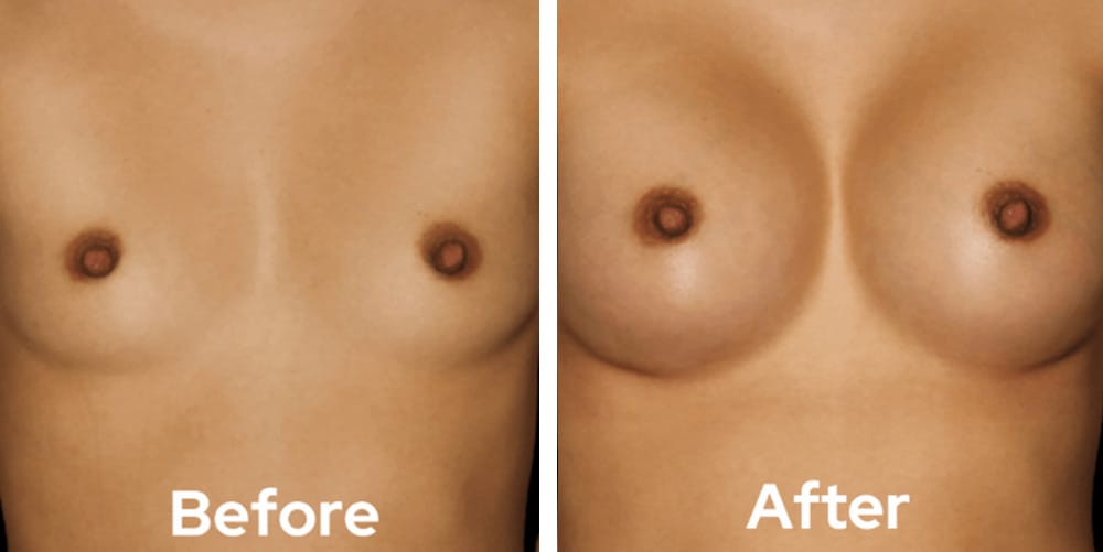 Breast Augmentation-dr-garg-before-after-04