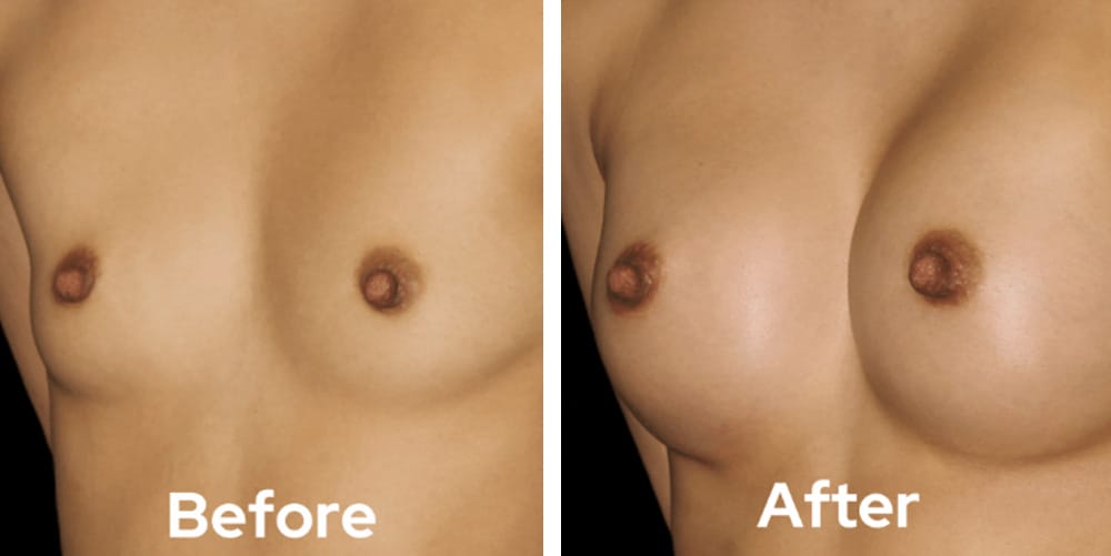 Breast Augmentation-dr-garg-before-after-05