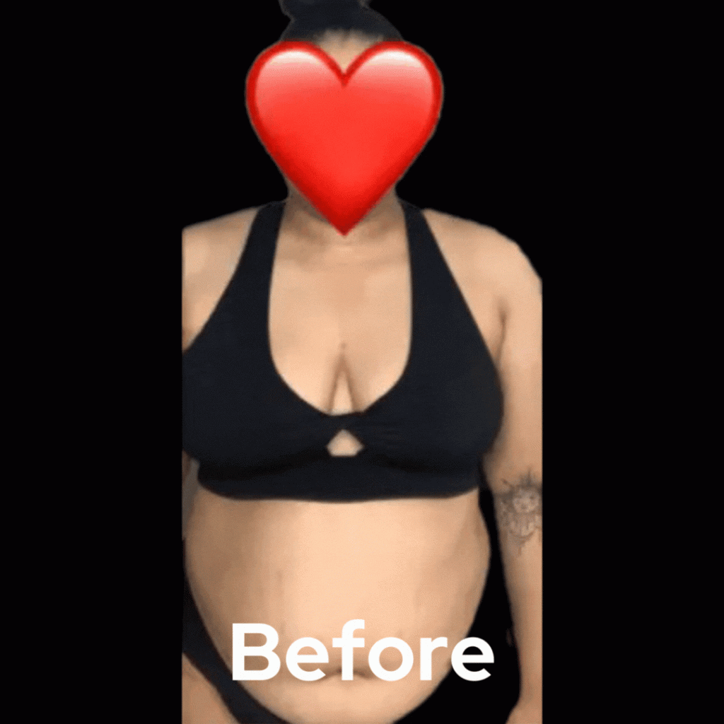 Liposuction before after