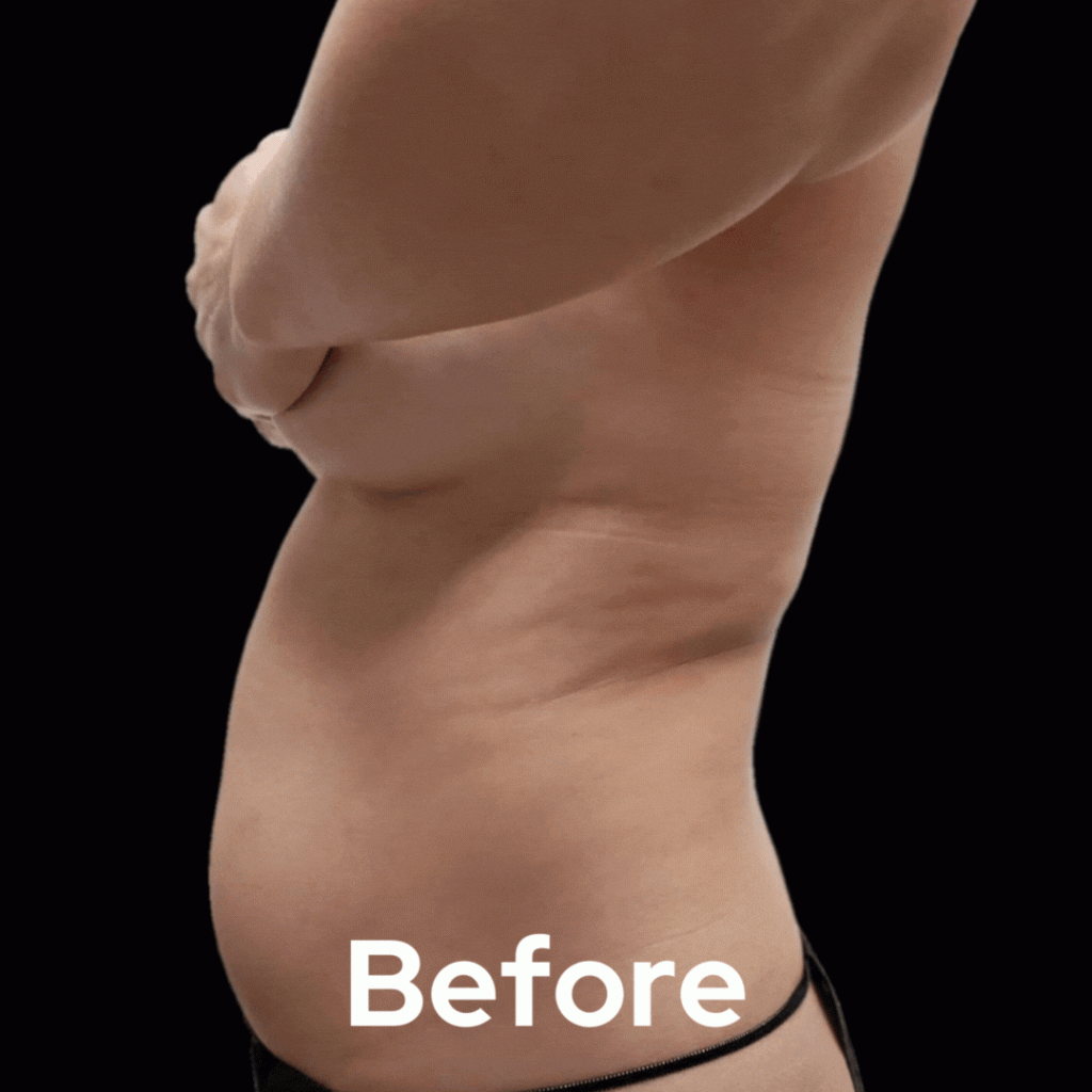 Liposuction before after 2