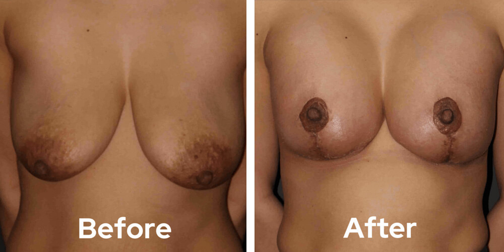 breast lift dr garg before after 03