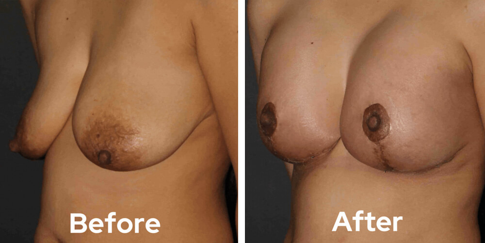 breast lift dr garg before after 04