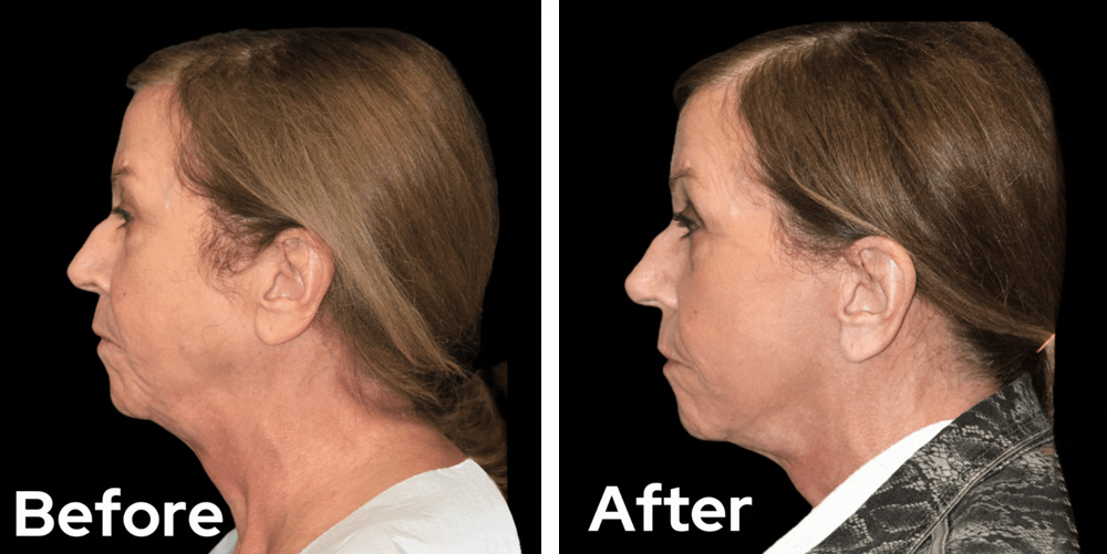 facelift-dr-garg-before-after-01
