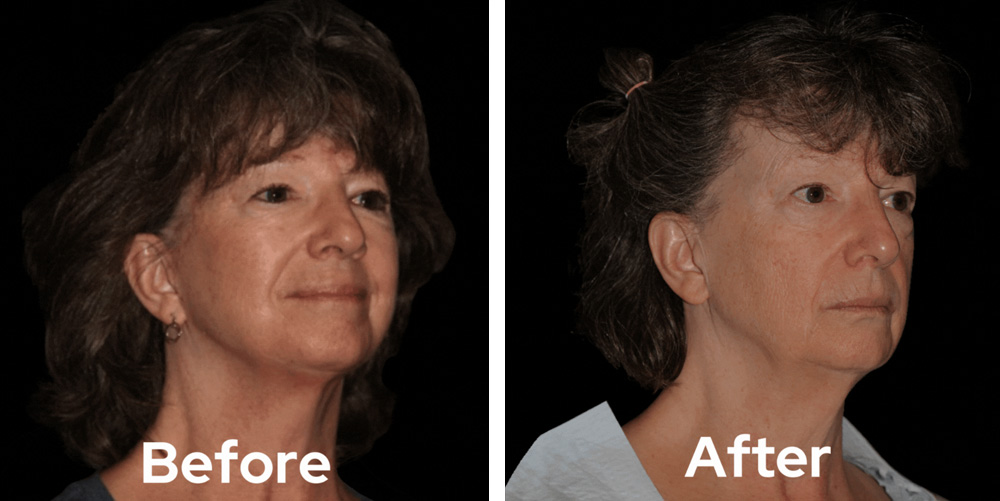 facelift-dr-garg-before-after-02