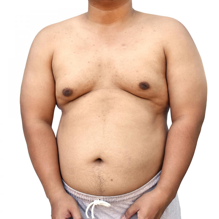 gynecomastia 05