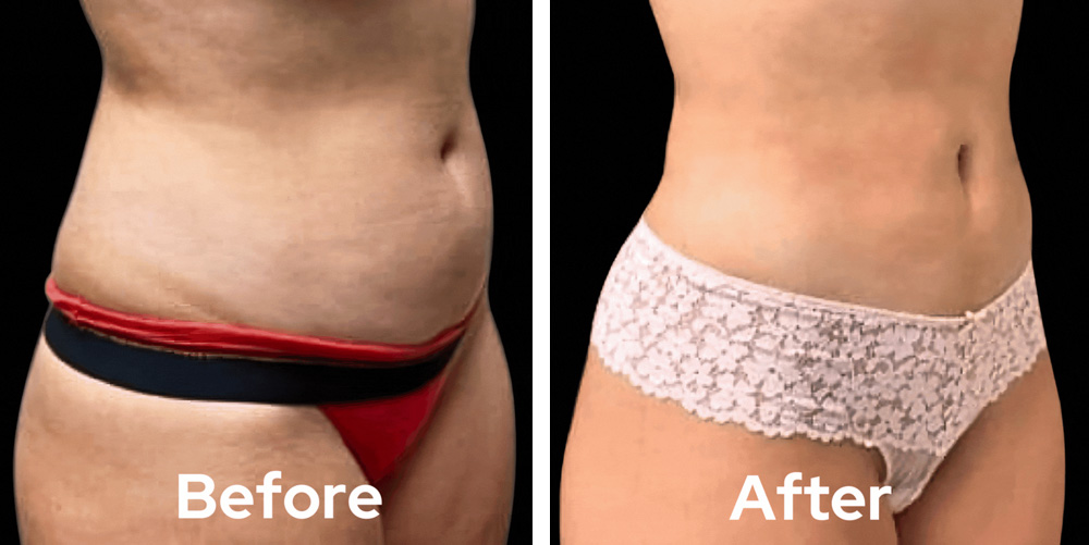 liposuction-dr-garg-before-after-03