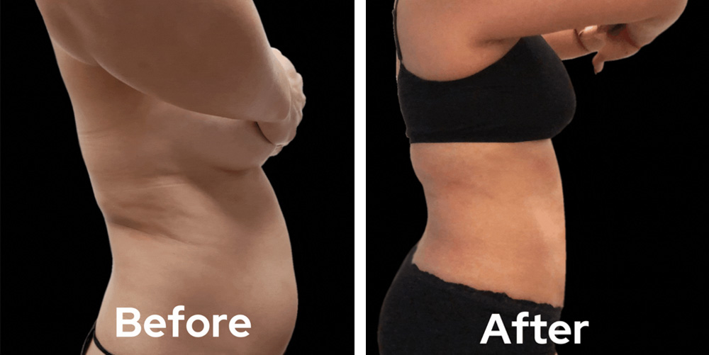 liposuction-dr-garg-before-after-01
