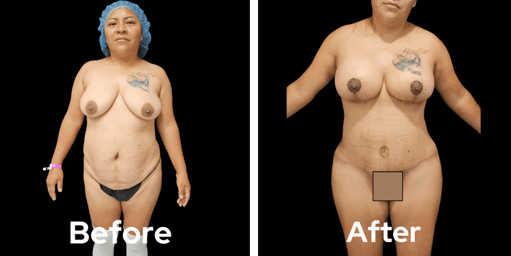 mommy-makeover-dr-garg-before-after-03