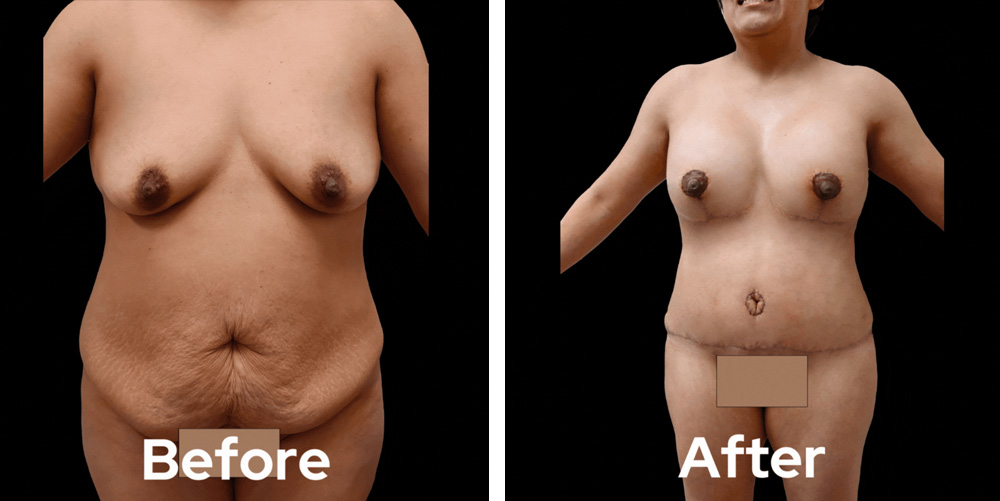 mommy-makeover-dr-garg-before-after-04