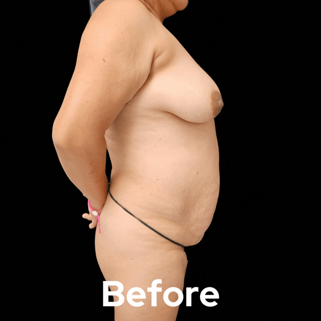 Mommy Makeover - Before and After 01