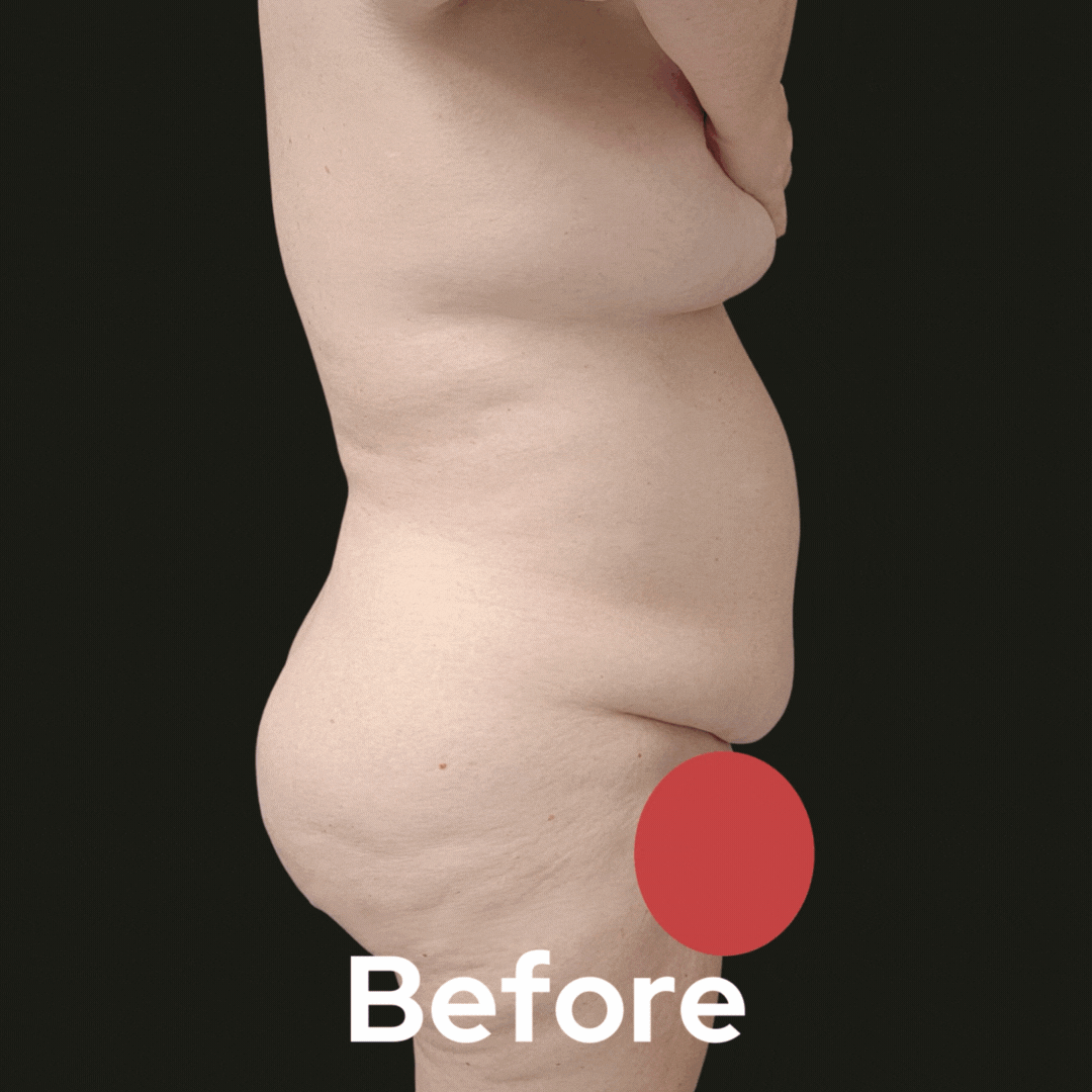 Tummy Tuck - Before and After 01