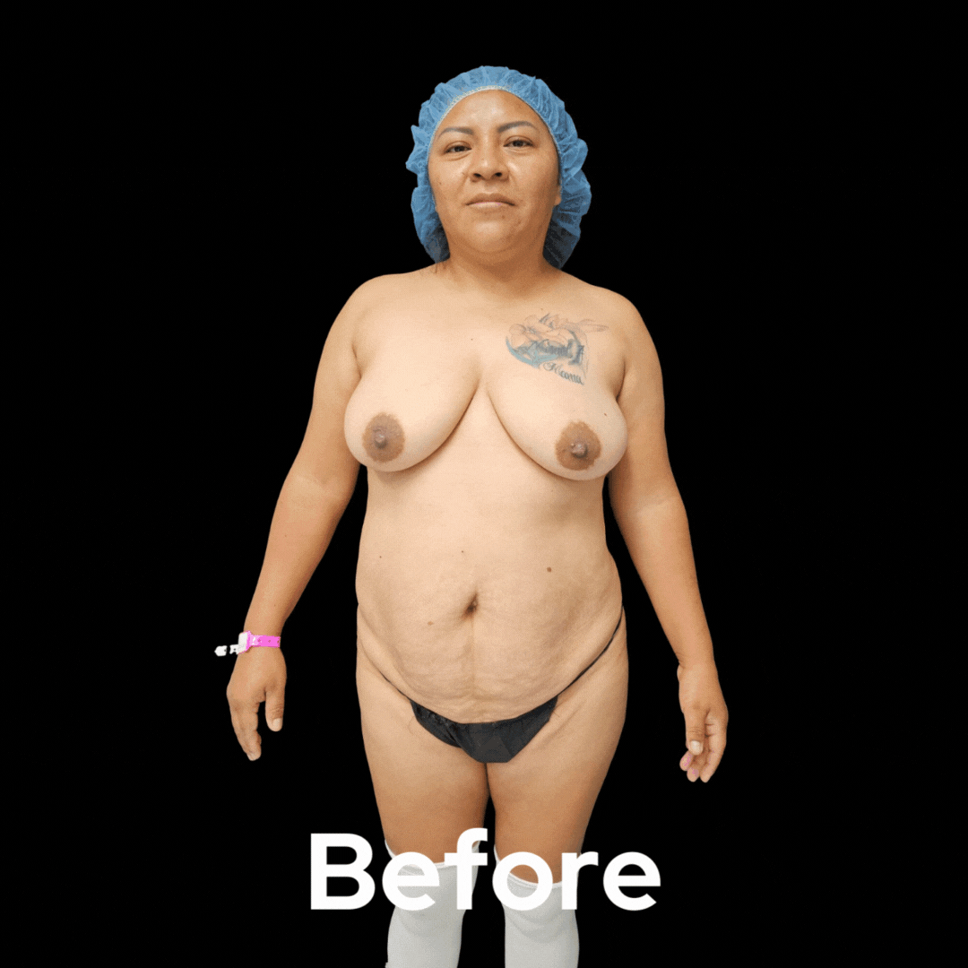 Mommy Makeover - Before and After 02