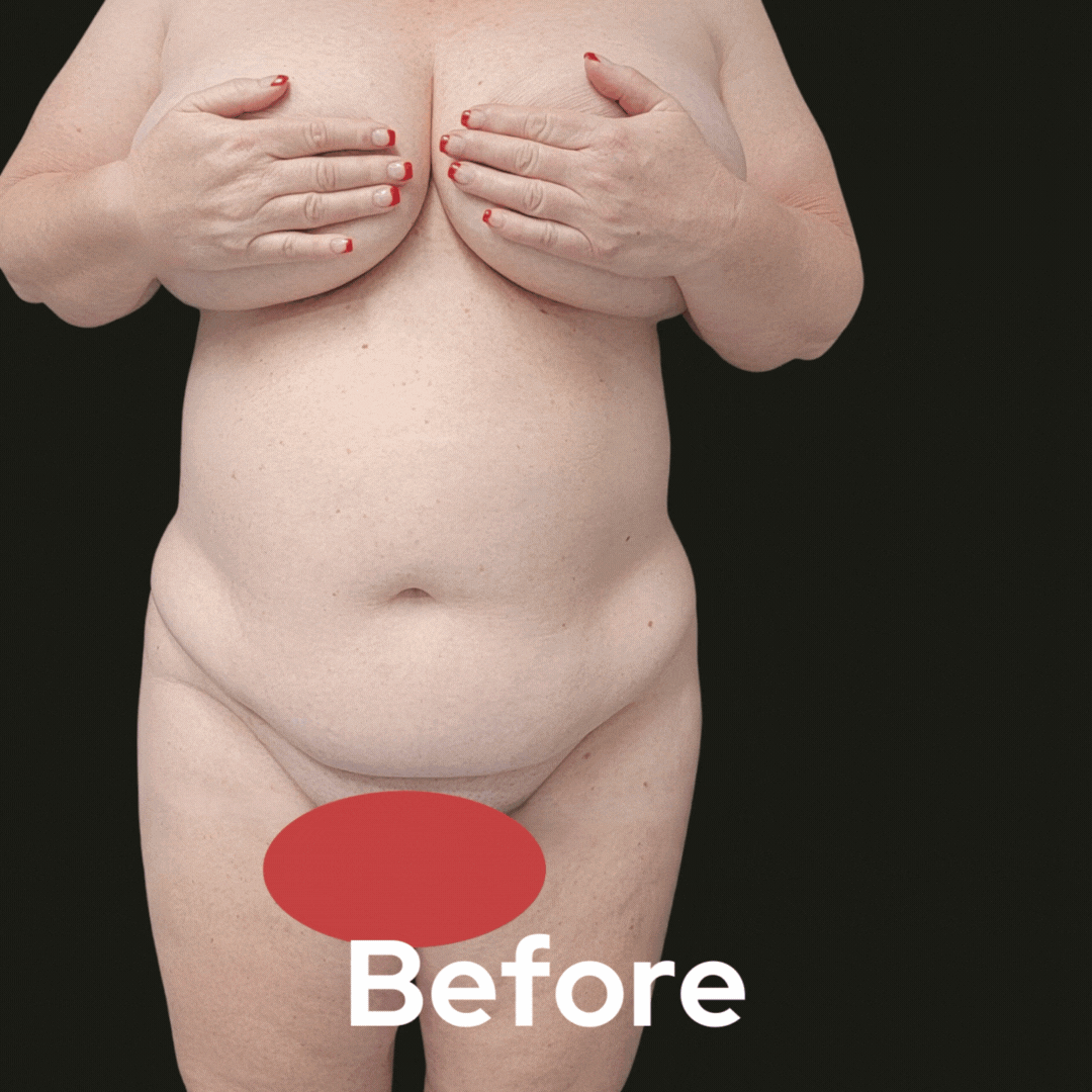 Tummy Tuck - Before and After 02