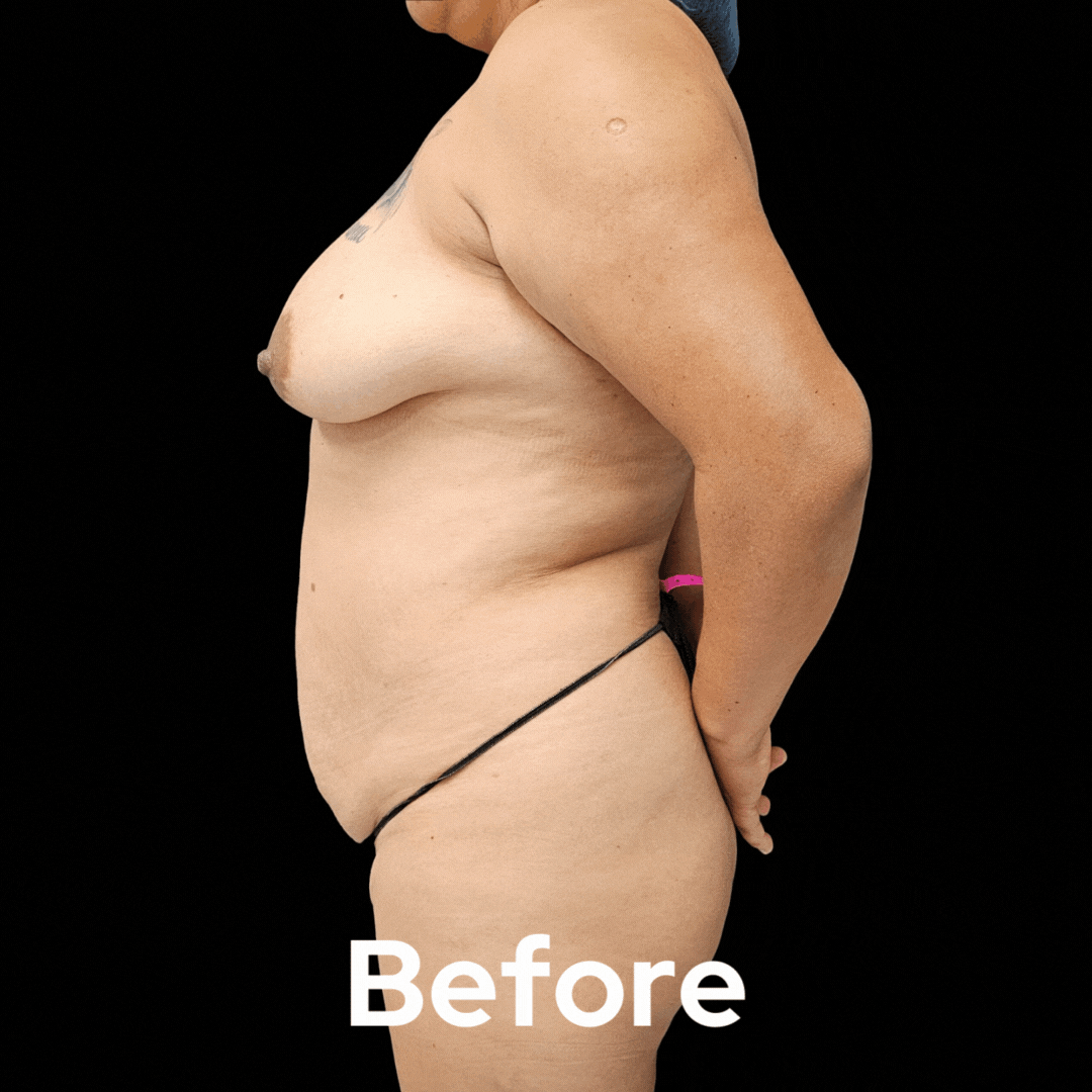 Mommy Makeover - Before and After 03