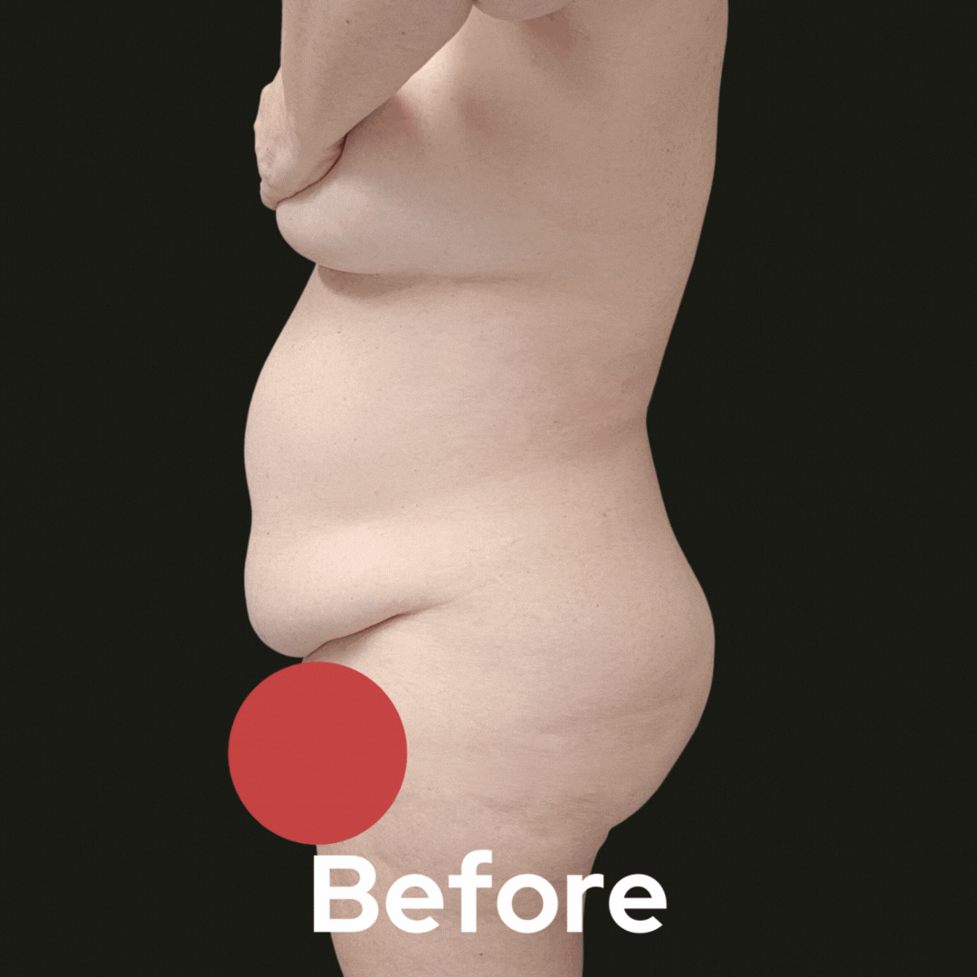 Tummy Tuck - Before and After 03