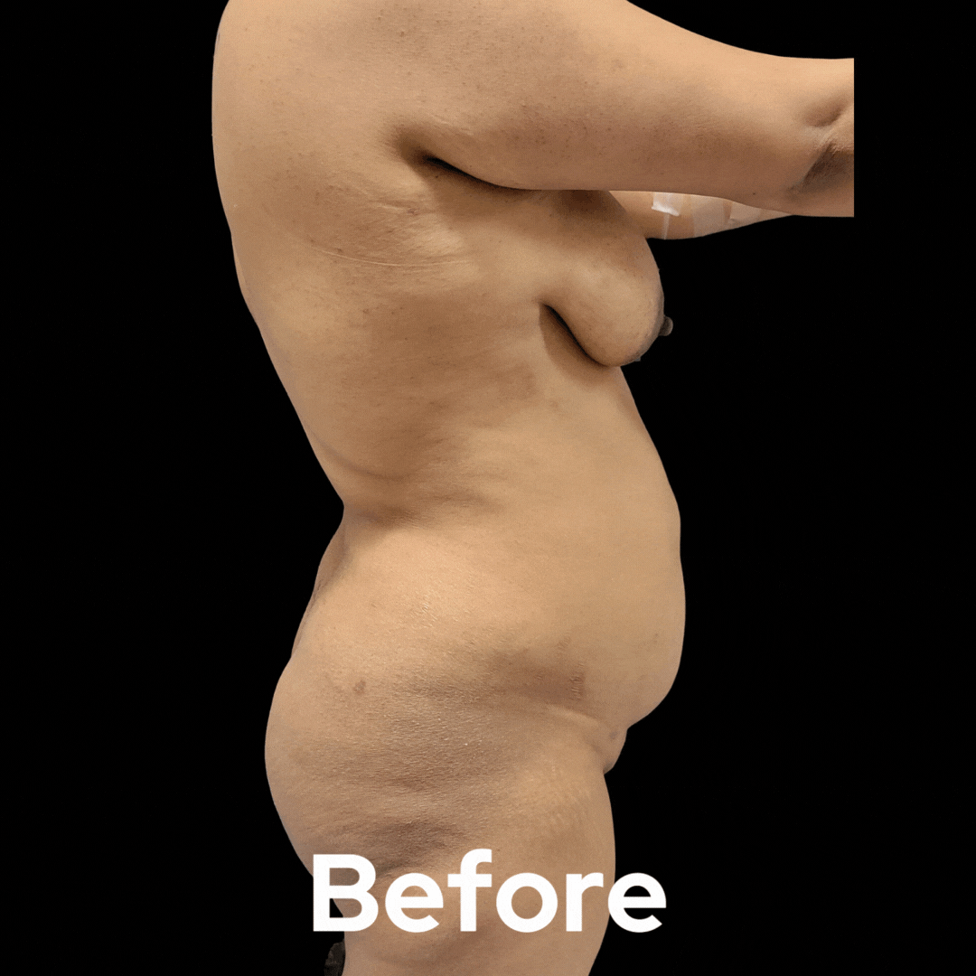 Mommy Makeover - Before and After 04