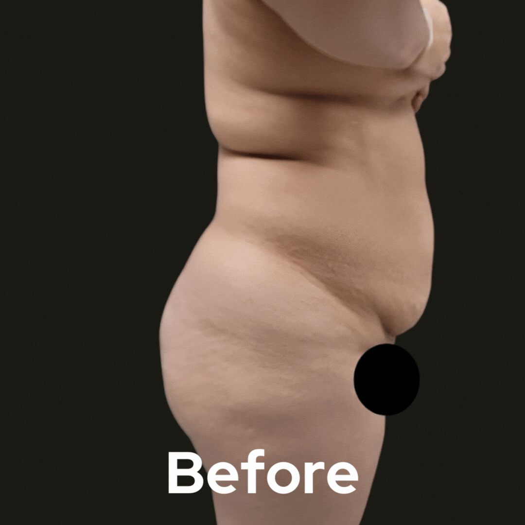 Tummy Tuck - Before and After 04
