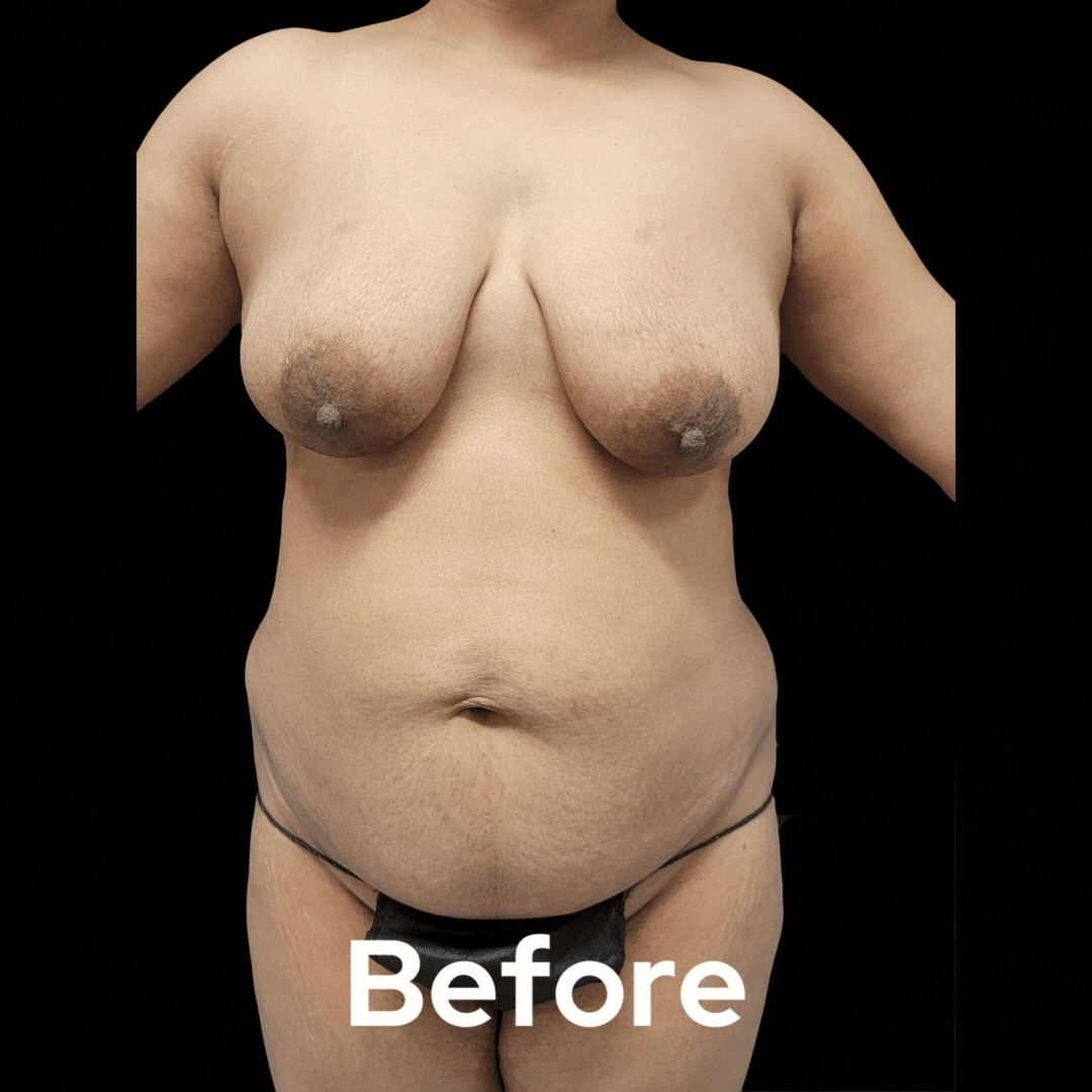 Mommy Makeover - Before and After 05