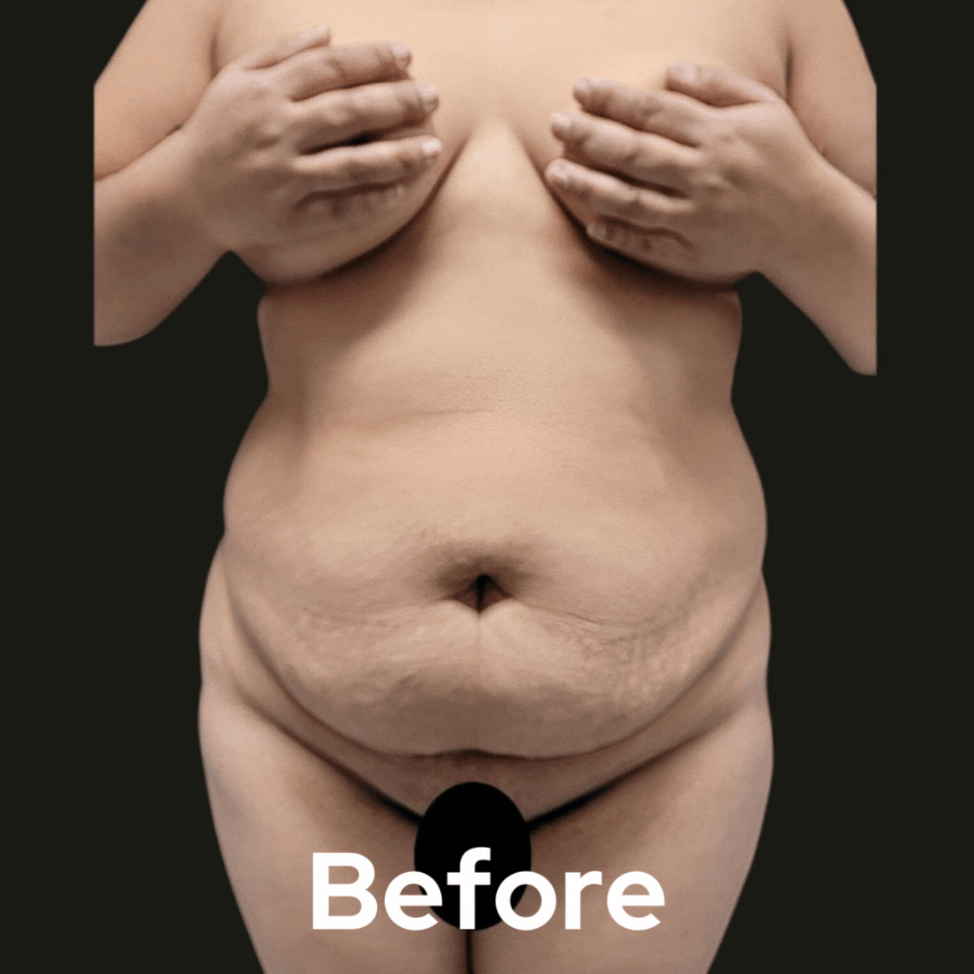 Tummy Tuck - Before and After 05