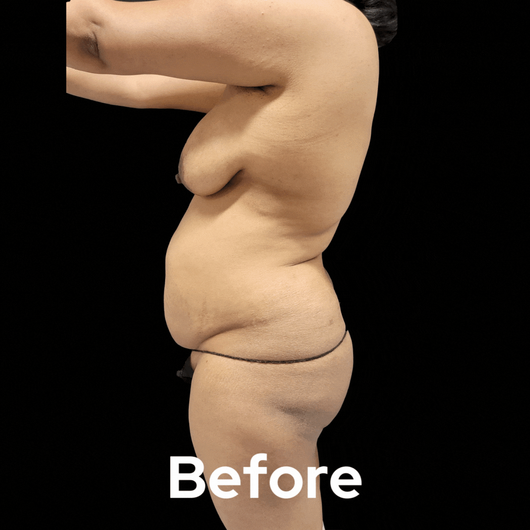 Mommy Makeover - Before and After 06