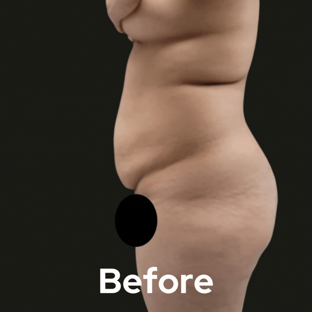 Tummy Tuck - Before and After 06