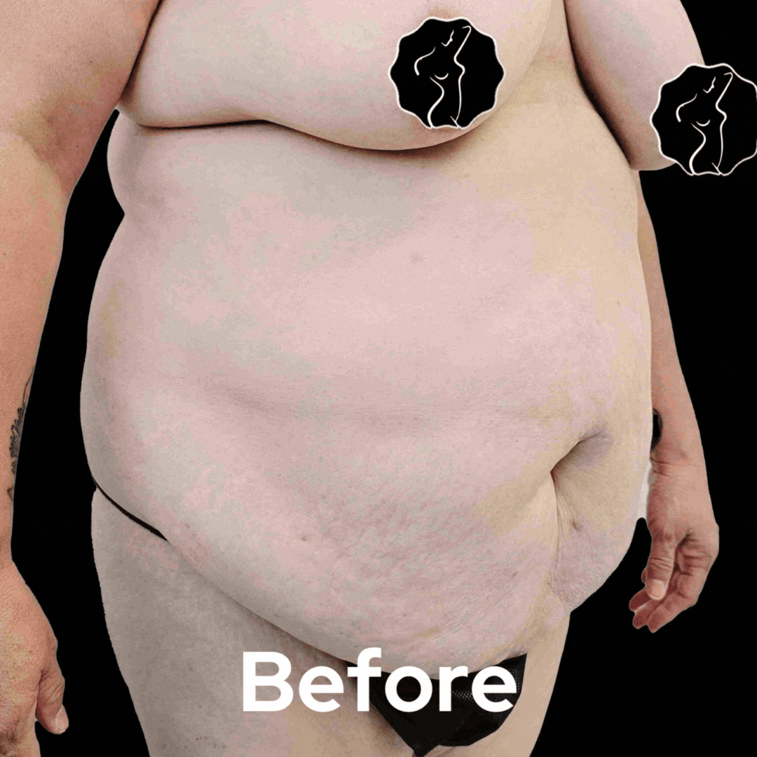 Tummy Tuck - Before and After 07