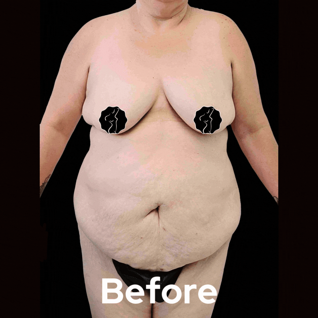 Tummy Tuck - Before and After 08