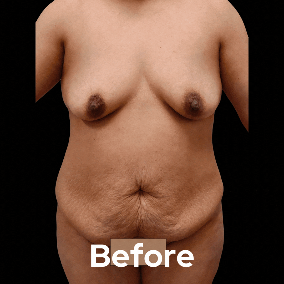 Mommy Makeover - Before and After 08