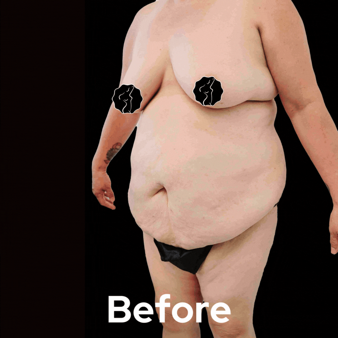 Tummy Tuck - Before and After 09