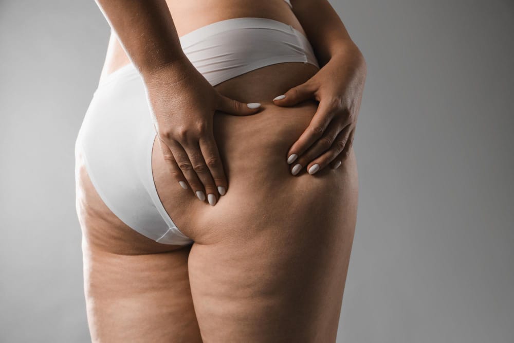 Cellulite treatment