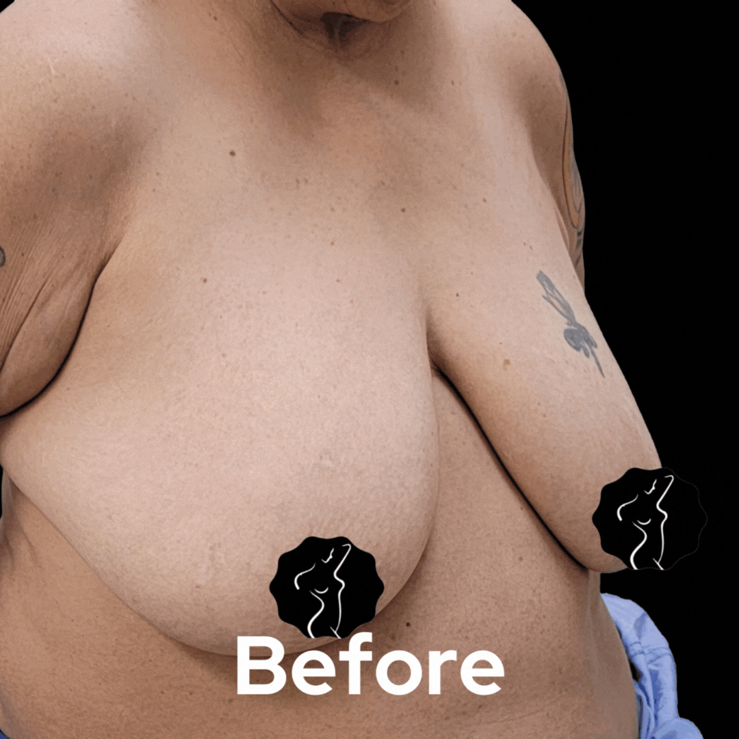 Breast Lift - Before and After 01