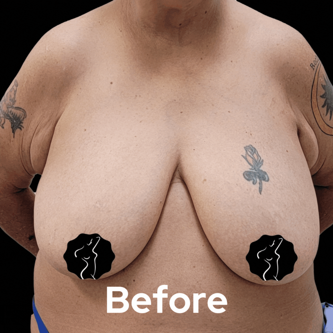 Breast Lift - Before and After 02