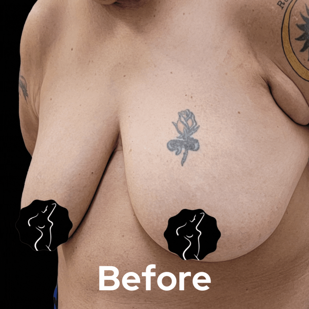 Breast Lift - Before and After 03