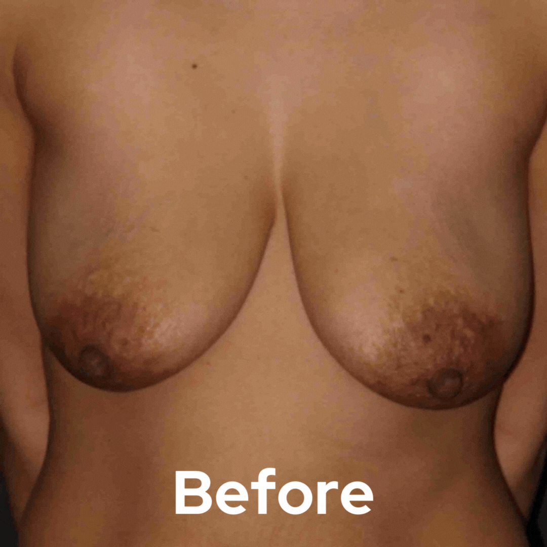 Breast Lift - Before and After 04
