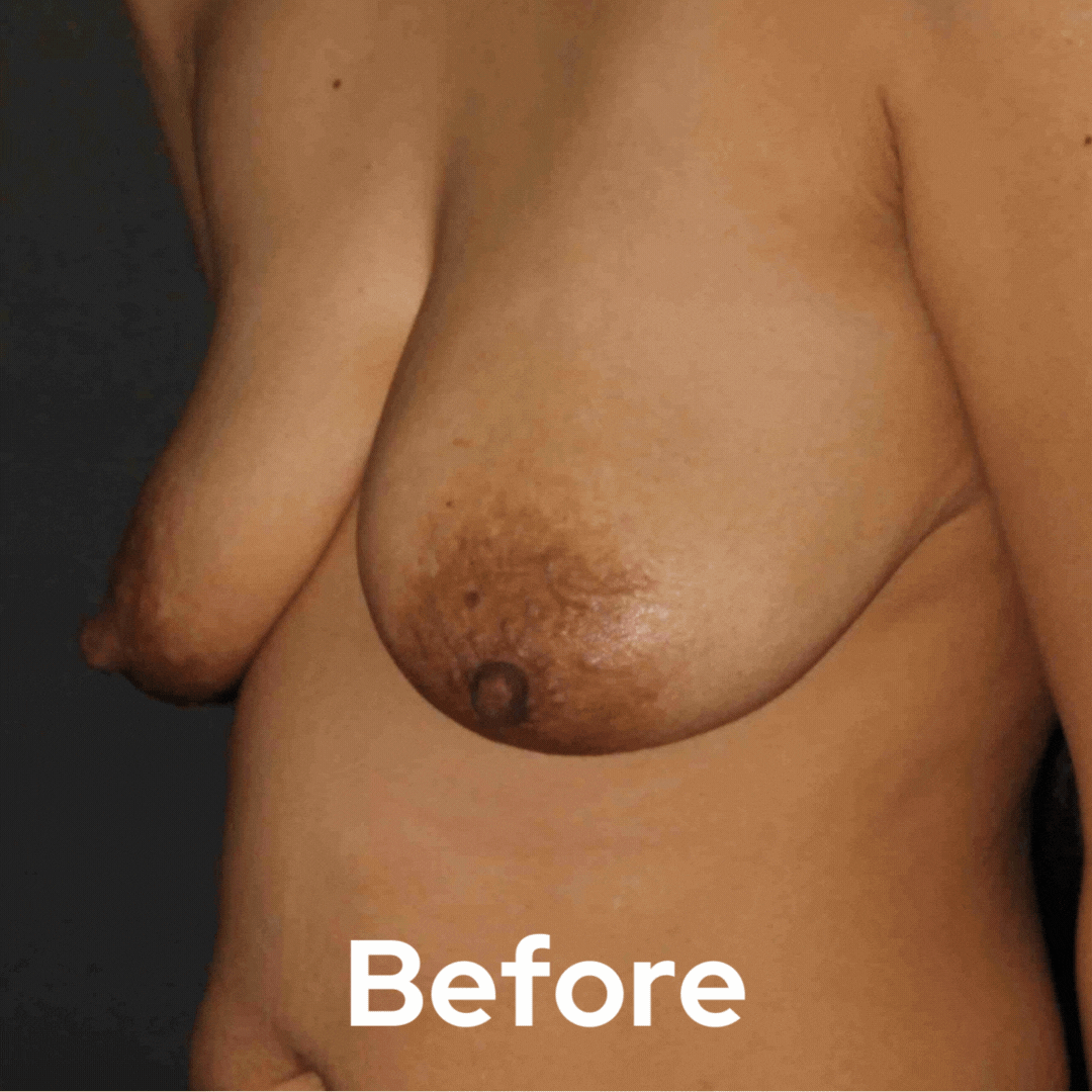 Breast Lift - Before and After 05
