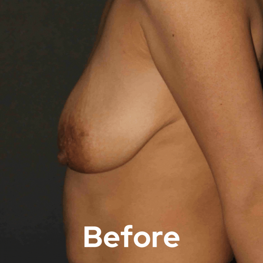 Breast Lift - Before and After 06