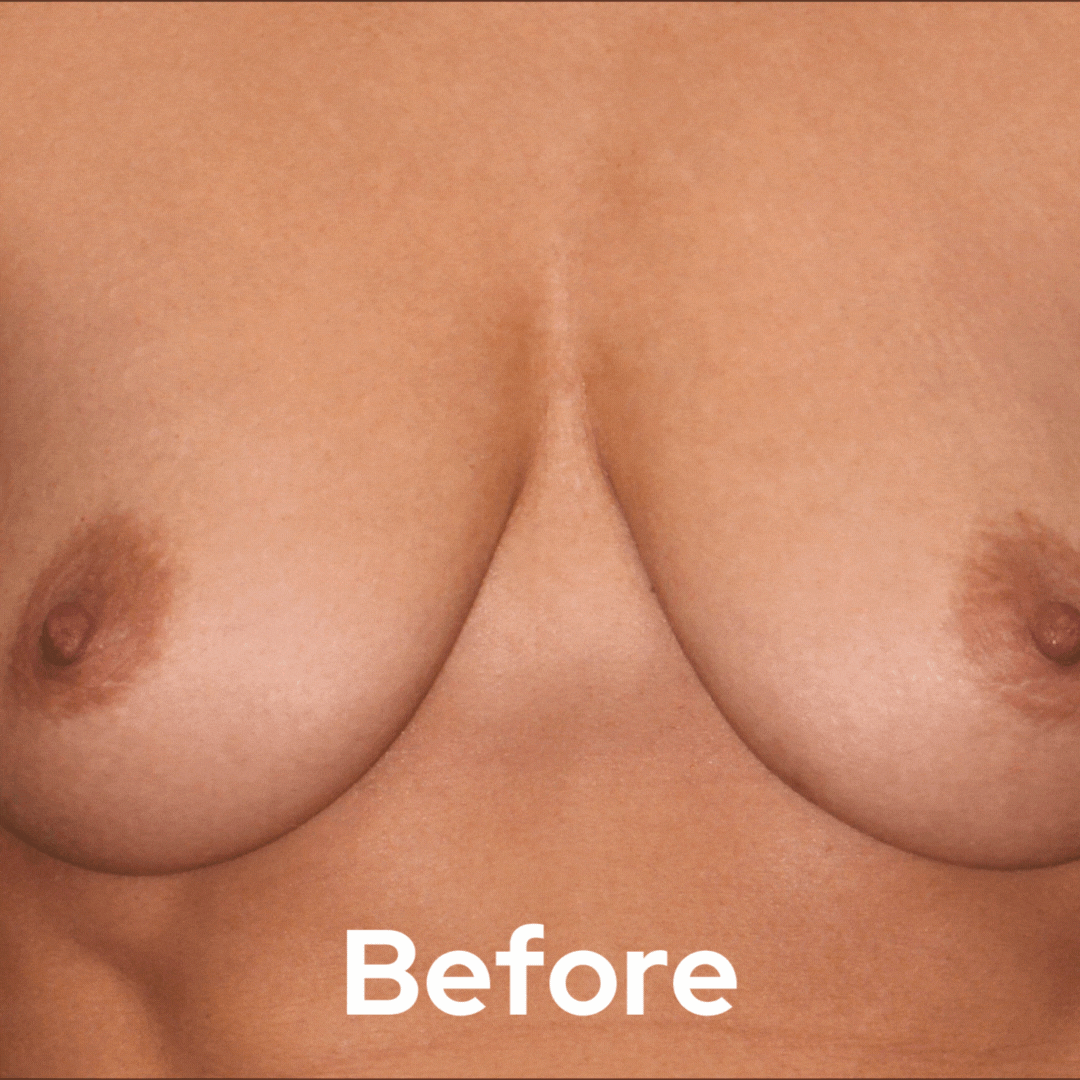 Breast Lift - Before and After 07