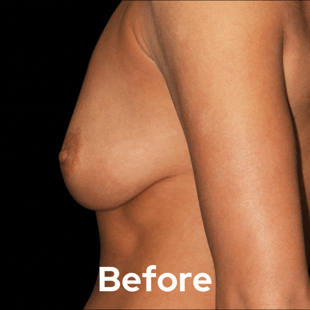 Breast Lift - Before and After 08