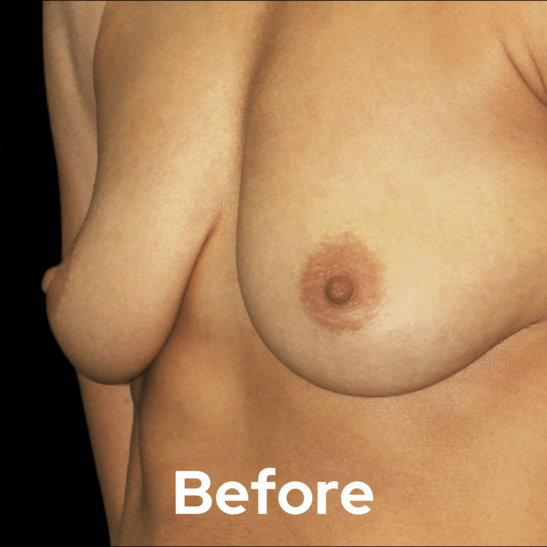 Breast Lift - Before and After 09