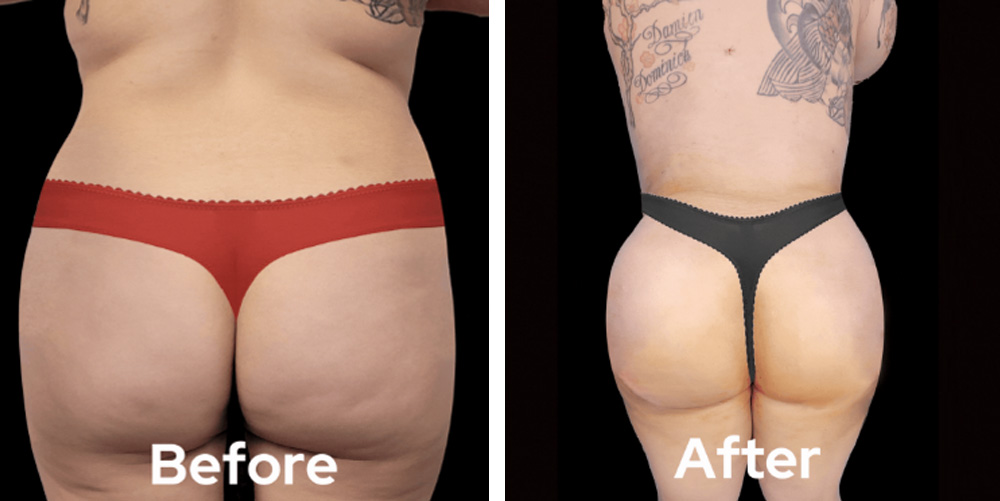 brazillian-butt-lift-dr-garg-before-after-01