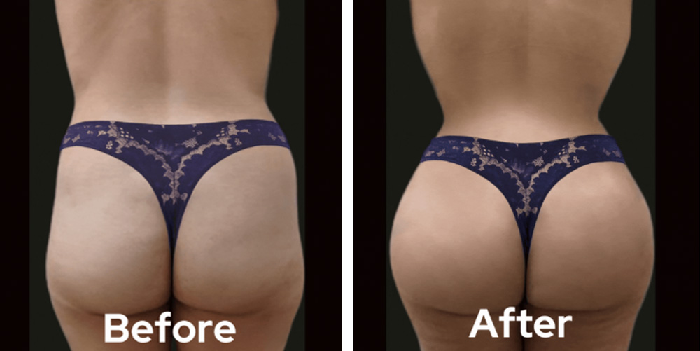 brazillian-butt-lift-dr-garg-before-after-02