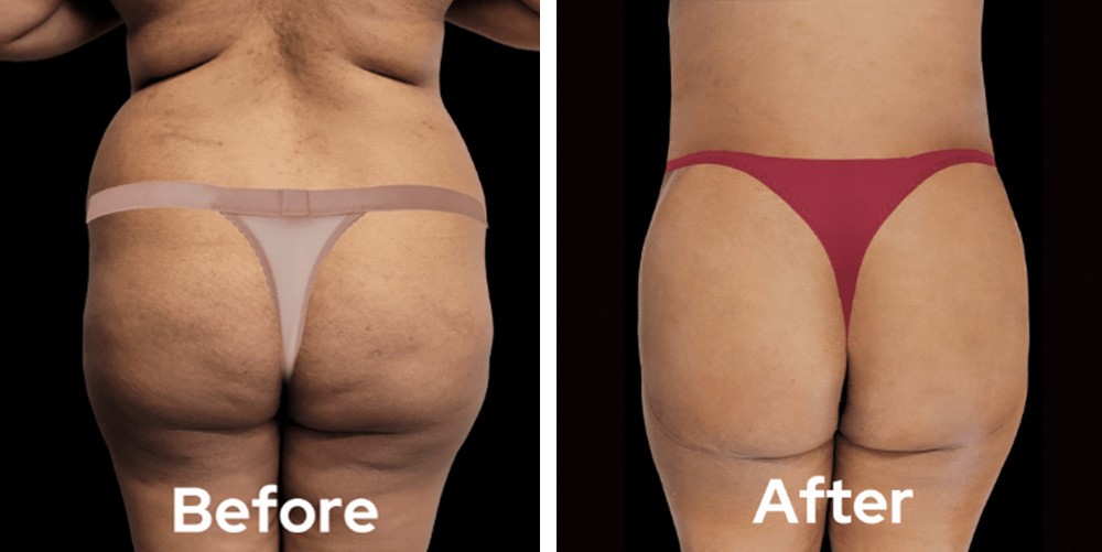 brazillian-butt-lift-dr-garg-before-after-03