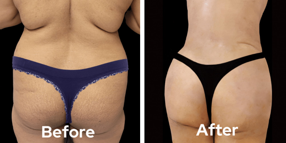 brazillian-butt-lift-dr-garg-before-after-05
