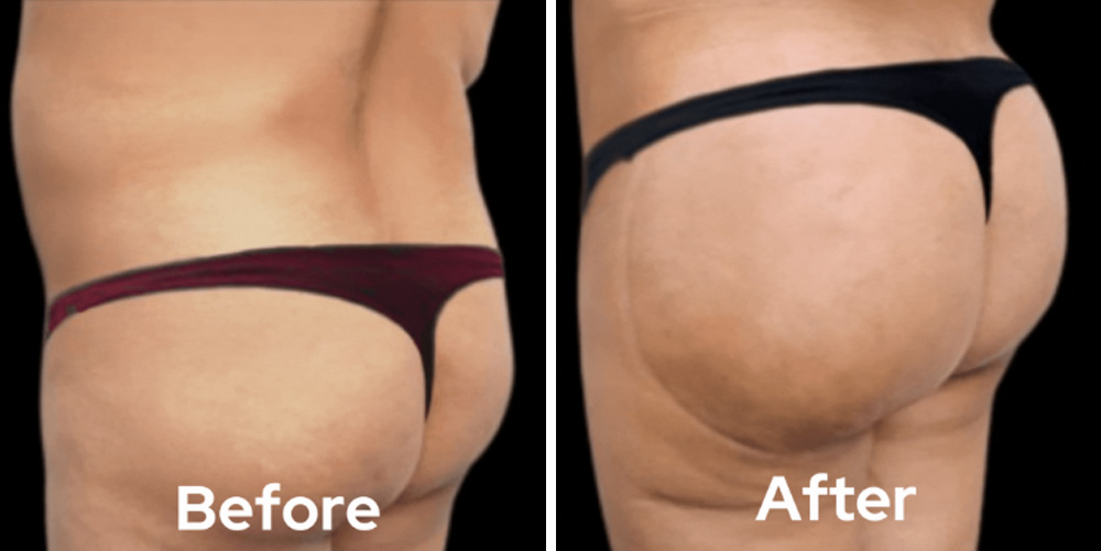 brazillian-butt-lift-dr-garg-before-after-06