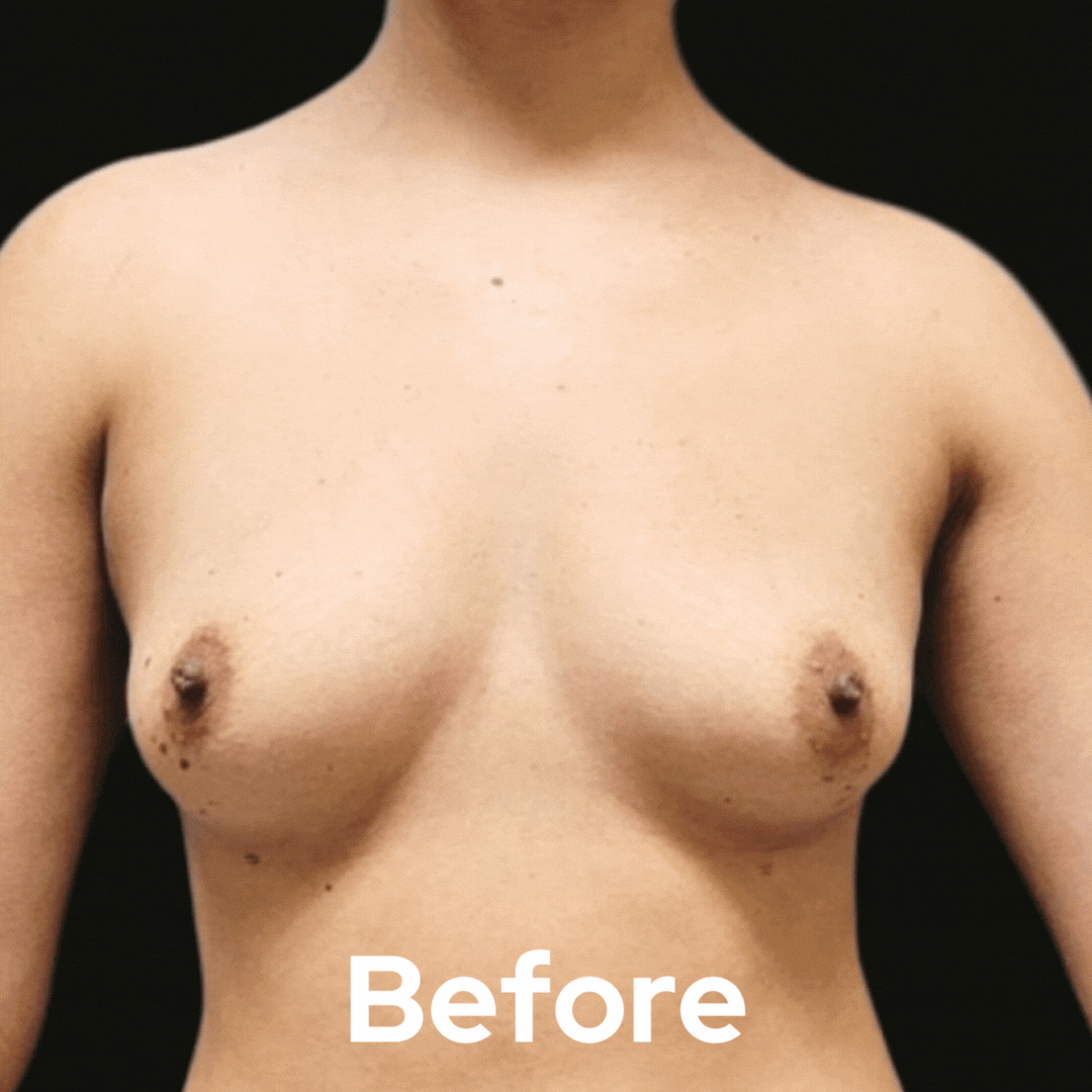 Breast Augmentation - Before and After 01