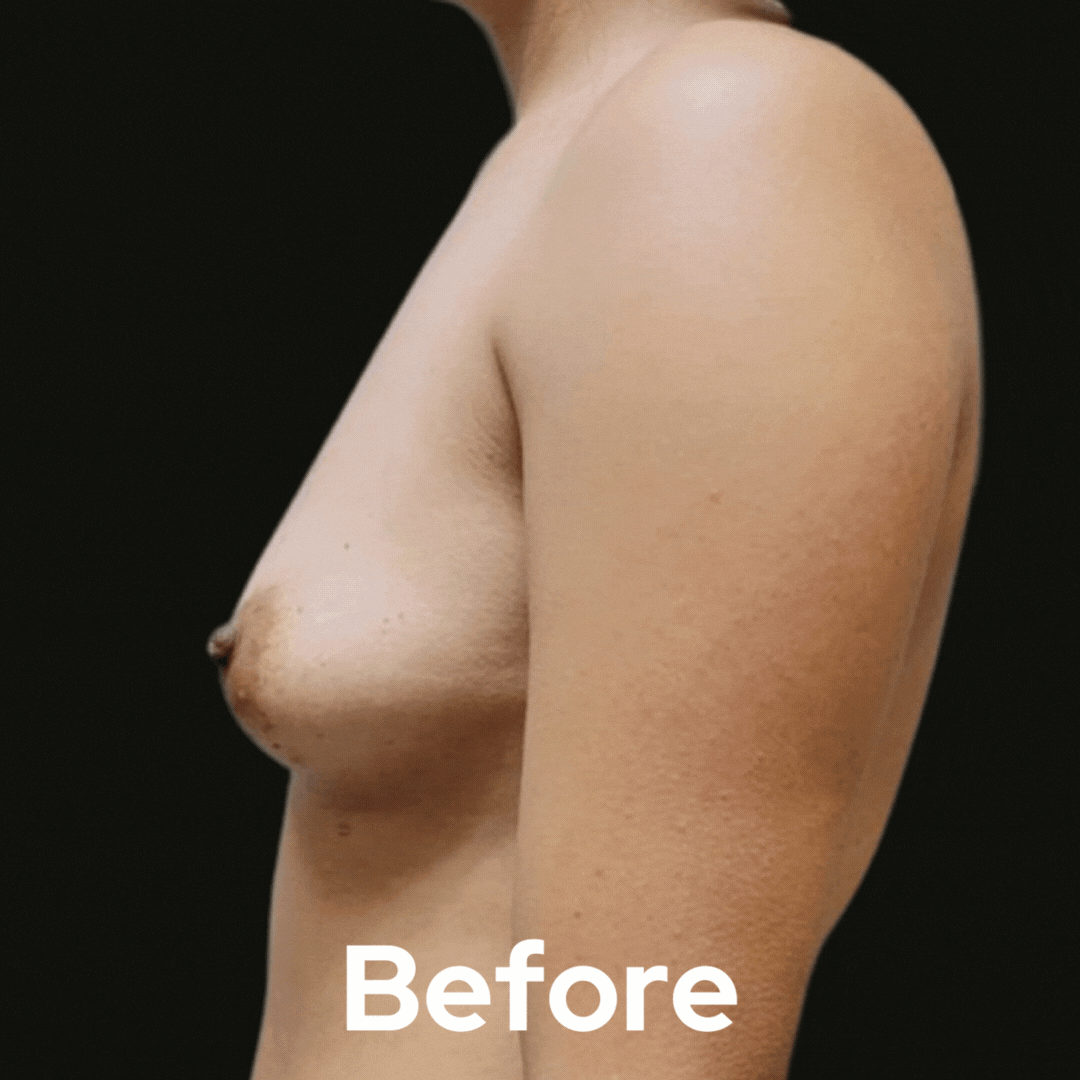 Breast Augmentation - Before and After 03