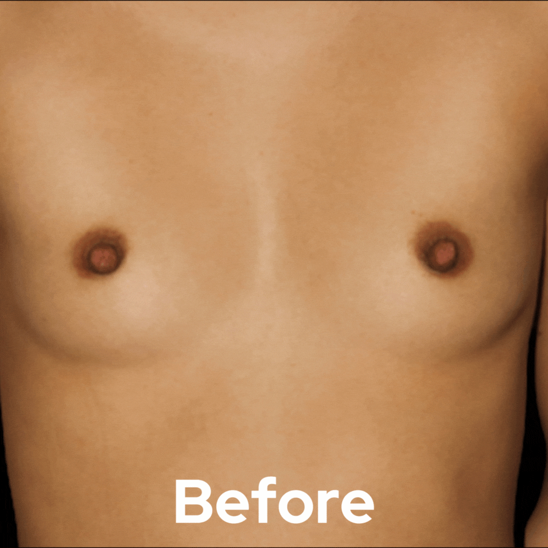 Breast Augmentation - Before and After 04