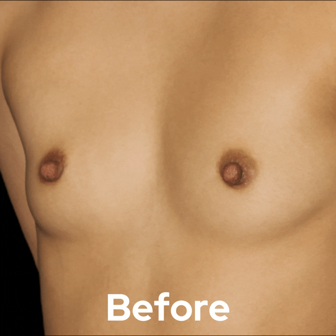 Breast Augmentation - Before and After 05